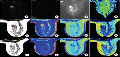 Multiparametric MRI model with synthetic MRI, DWI multi-quantitative parameters, and differential sub-sampling with cartesian ordering enables BI-RADS 4 lesions diagnosis with high accuracy